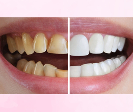 Laser-Assisted Root Canal Therapys